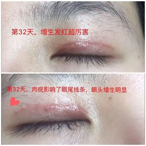 双眼皮开眼角瘢痕增生了?不用怕!