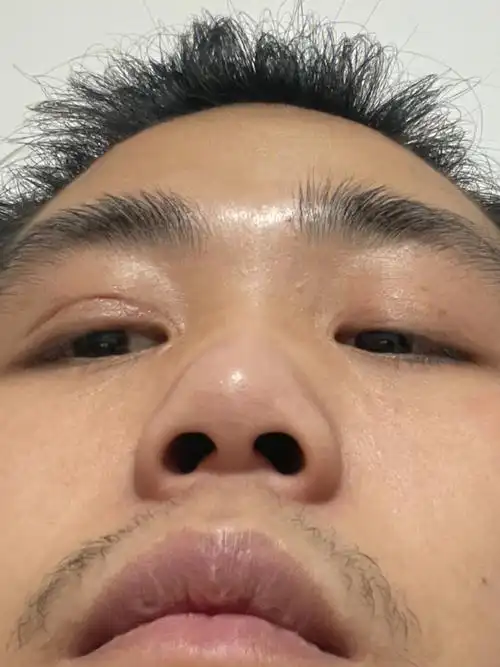 眼睑外翻已经三个月了怎么办呀哎