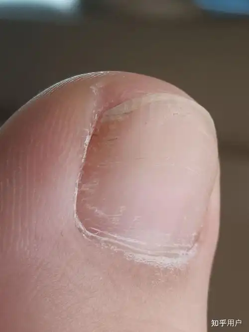 大脚趾甲有一条特别深的横纹,看起来跟裂开了一样,想请教一下这是怎么