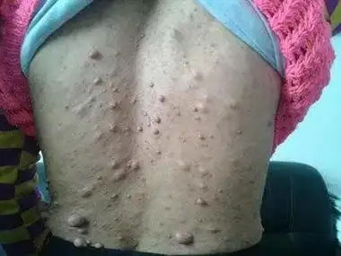 手臂上脂肪瘤图片大全 - 搜狗图片搜索