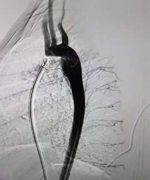 多科协作,将1岁半女童大到6毫米的心脏缺口给堵严实了