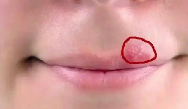 嘴巴周围时不时出现几个水泡提示这不是上火会传染