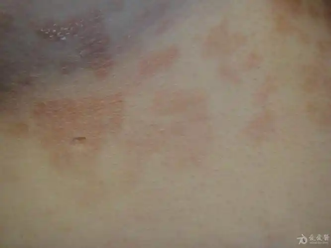 典型皮肤病之花斑癣(汗斑)