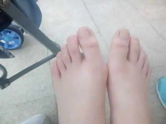如图,10岁女孩,脚趾拇指严重向内弯,是不是趾骨发育有问题呢?