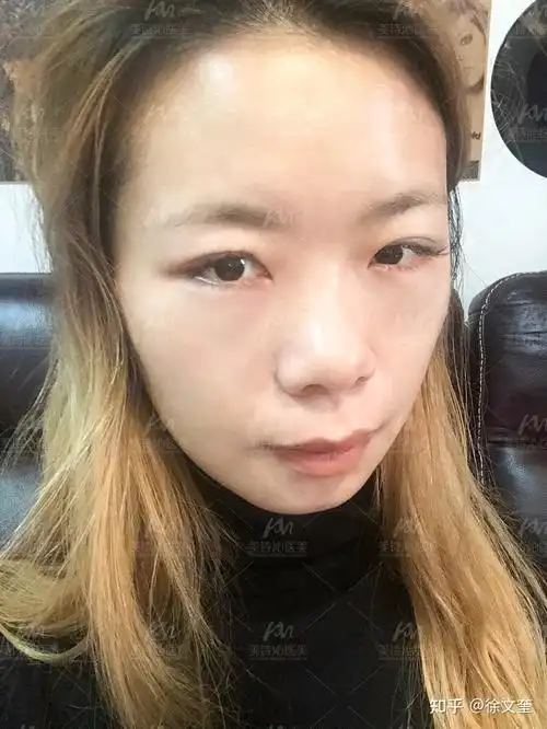 去眼袋手术失败,结局能有多惊悚? - 知乎