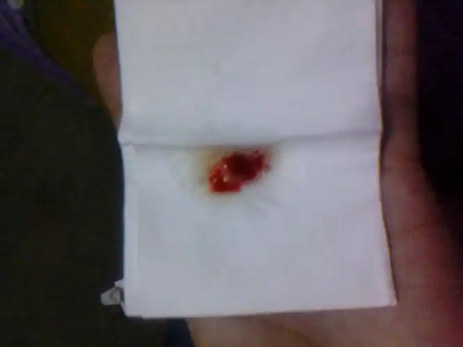 大量咳黄痰                咳血痰