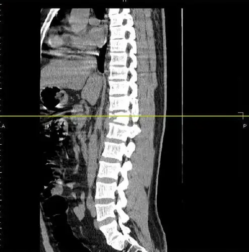 胸12椎体爆散骨折,胸髓损伤,双下肢不全瘫,胸腹联合切口 - 好大夫在线