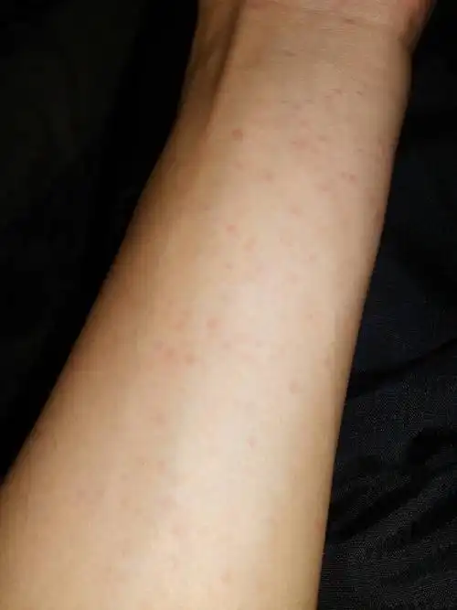 洗澡后手臂和手掌会出现很多小红点,不痒也不痛,出现后会渐渐消退.