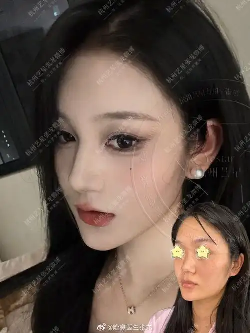 短塌鼻77面中凹陷改善 术后半个月肋骨包裹筋膜增加鼻子高度立体度