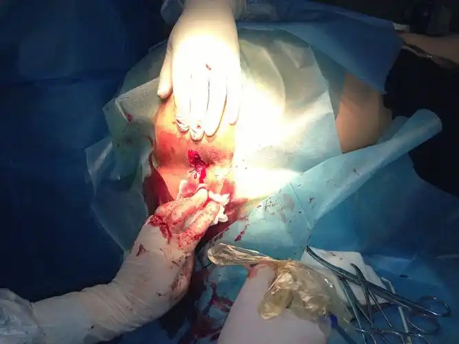 混合痔伴血栓术前术中和术后