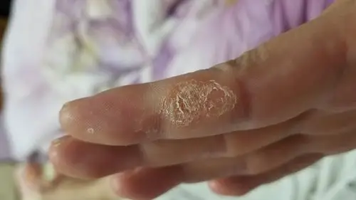 手指老是起硬皮,不痛不痒,搽999皮炎平 红 绿款都没用