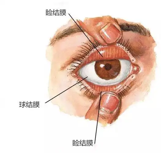 结膜,我们可以理解为眼睛里一层"裸奔的膜",覆盖在眼睑内面及"眼白"