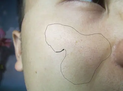 两边脸上颧骨位置皮肤有黑头变得不光滑.而且慢慢的在变宽