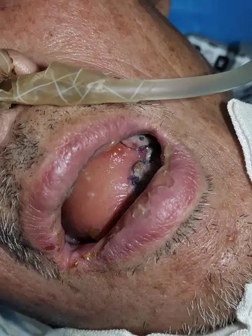 后请口腔科,手足显微外科,心内科协助诊治,于2020-12-15日行右舌癌