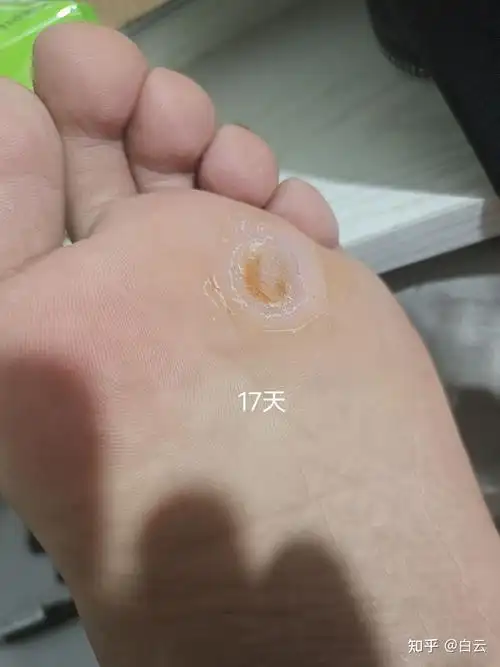 鸡眼的治愈全过程 - 知乎