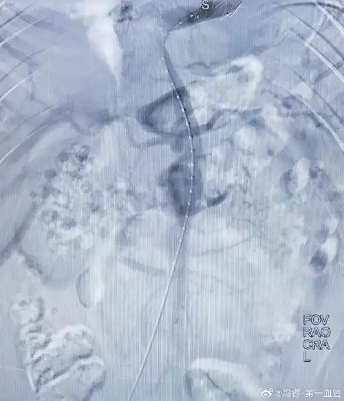 主动脉夹层##腹主动脉瘤##第一血管