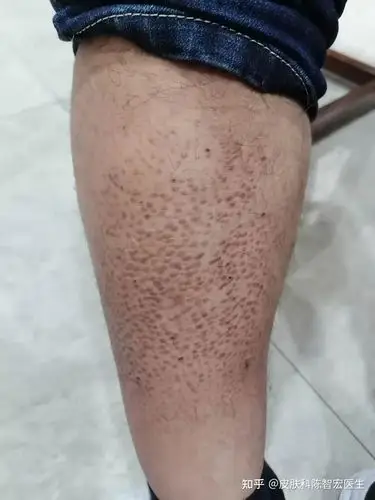 淀粉样变肾病可以治好么