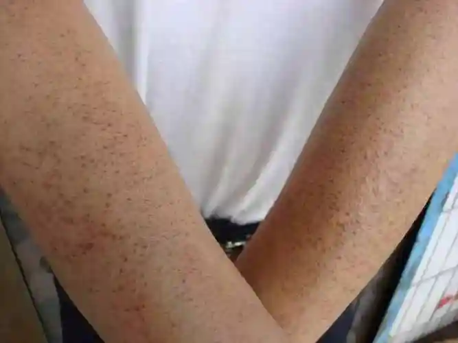 毛周角化症用什么药膏毛周角化症早期图片