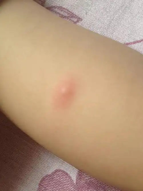 宝宝起了好几个红疙瘩,疙瘩中间还有水泡,谁知道是怎么回事吗?