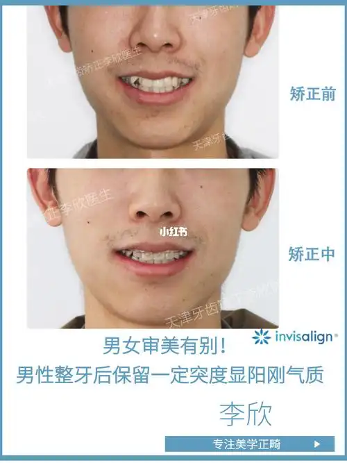 天津牙齿矫正73男性正畸需保持恰当面突度