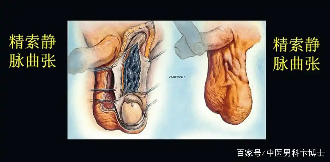 精索静脉曲张导致的男性生育问题手术治疗是最好选择