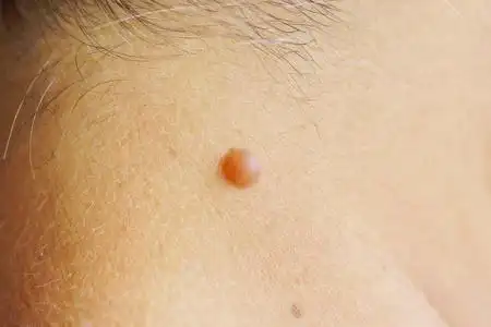 协管瘤白种人皮肤乳头状瘤照片