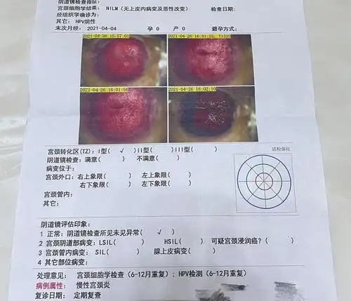 求助细菌性阴道炎慢性宫颈炎要怎么治疗