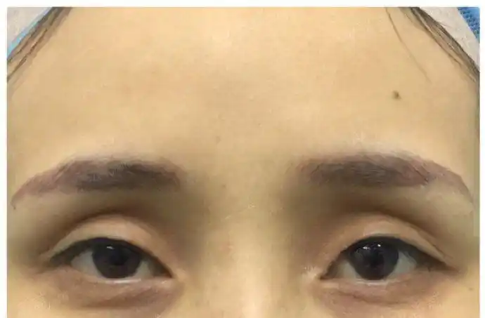 分析眼睛凹陷的面相男人和女人眼睛凹陷有什么区别