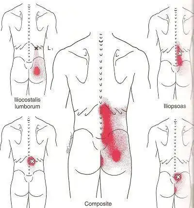 腰肌劳损怎样消除压痛点