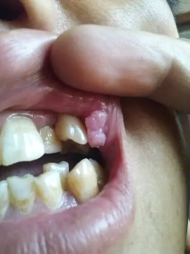 被虎牙咬破嘴了 之后长了块息肉 一不小心就会咬到