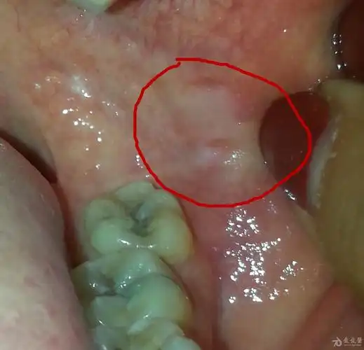 求助急求各位高手帮忙诊断是否口腔白斑