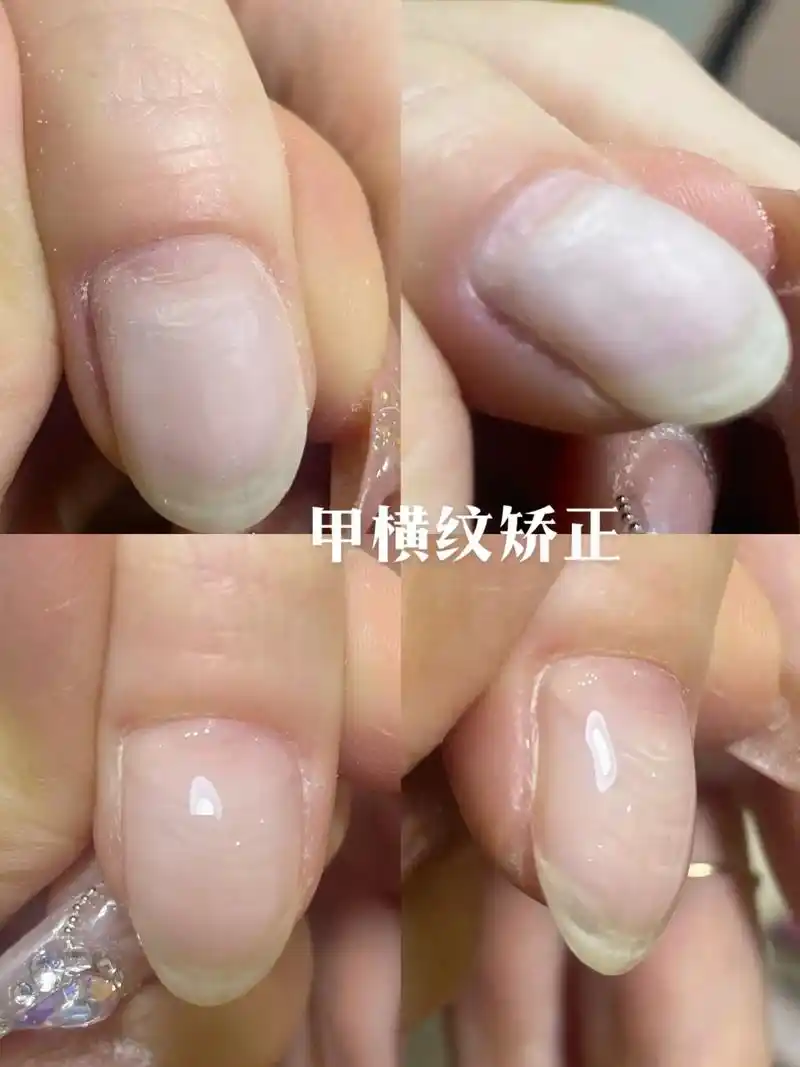 太原美甲 | 矫正美甲.横纹深粗者/表示一次严重的疾病 指甲 - 抖音