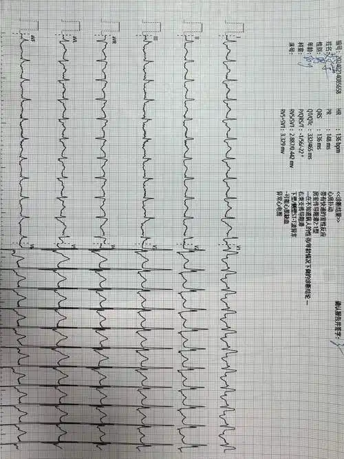 求指教这个心电图诊断