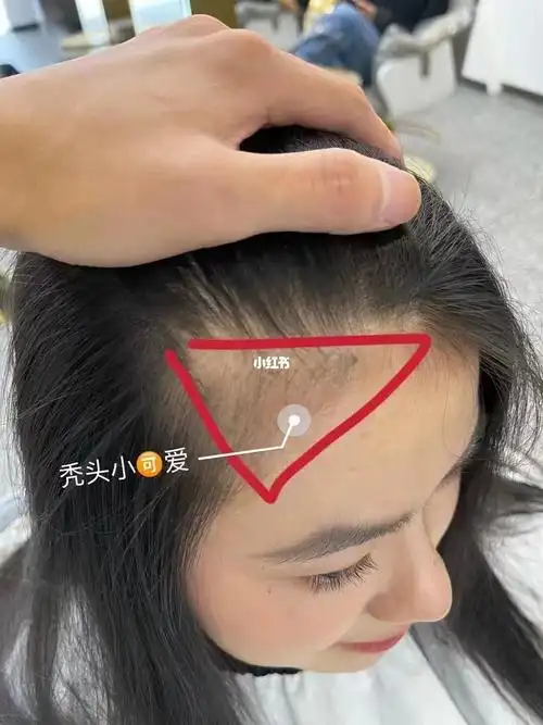 秃了20多年的发际线 终于被解决了