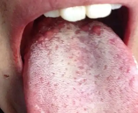 怎么长那么多泡什么情况