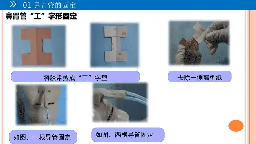 各种常见留置管道的固定方法pptppt
