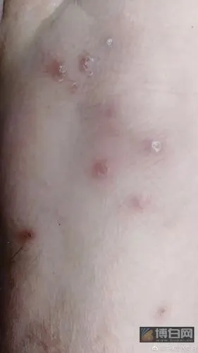玉林一妹子被蚂蚁咬了一口,10天还没有好