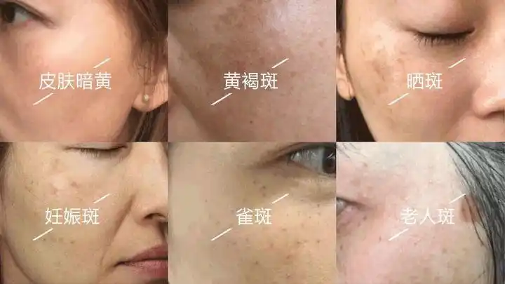 如何祛斑效果好?四个祛斑有效方法化解色斑危机