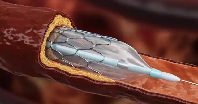 心脏支架术后要警惕胃病!