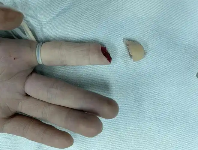 揪心,手指离断伤接二连三,医生提醒发生意外正确处理或可挽回