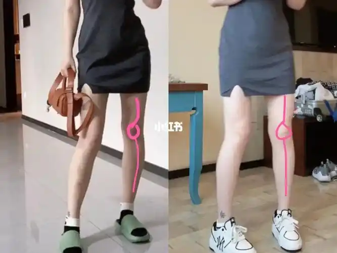 亲测改善小腿外翻实操手册02如何辨别自己