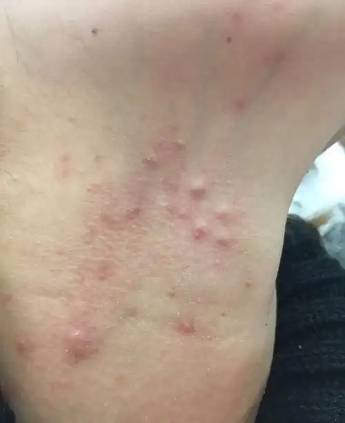 耳朵后边的皮脂腺囊肿图片