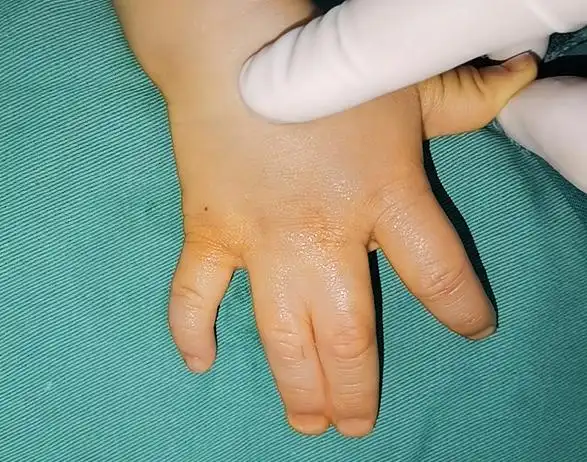 并指分指手术,植皮好还是皮肤再生好?