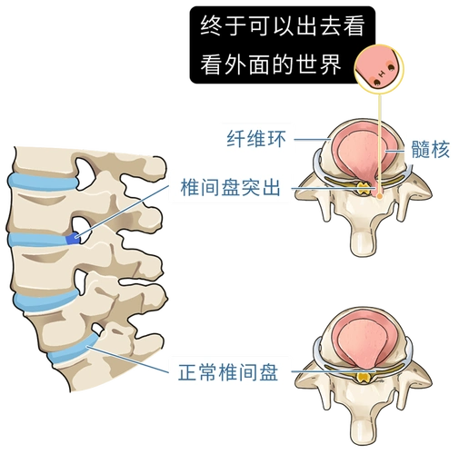 腰椎间盘突出用几张图简单直观地解释看完立马挺直了腰杆
