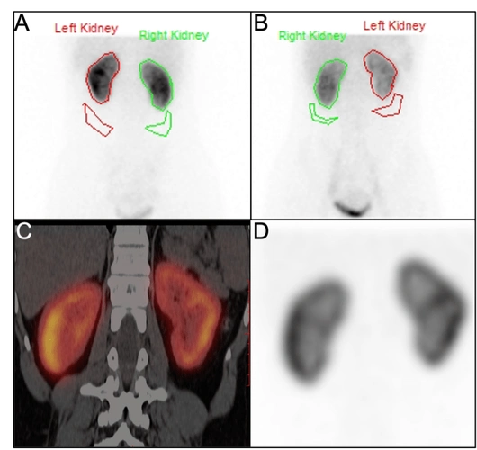 肾有点不对劲悄悄来医院做这个检查就晓得了