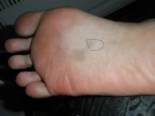 脚心血管有一点突出来.