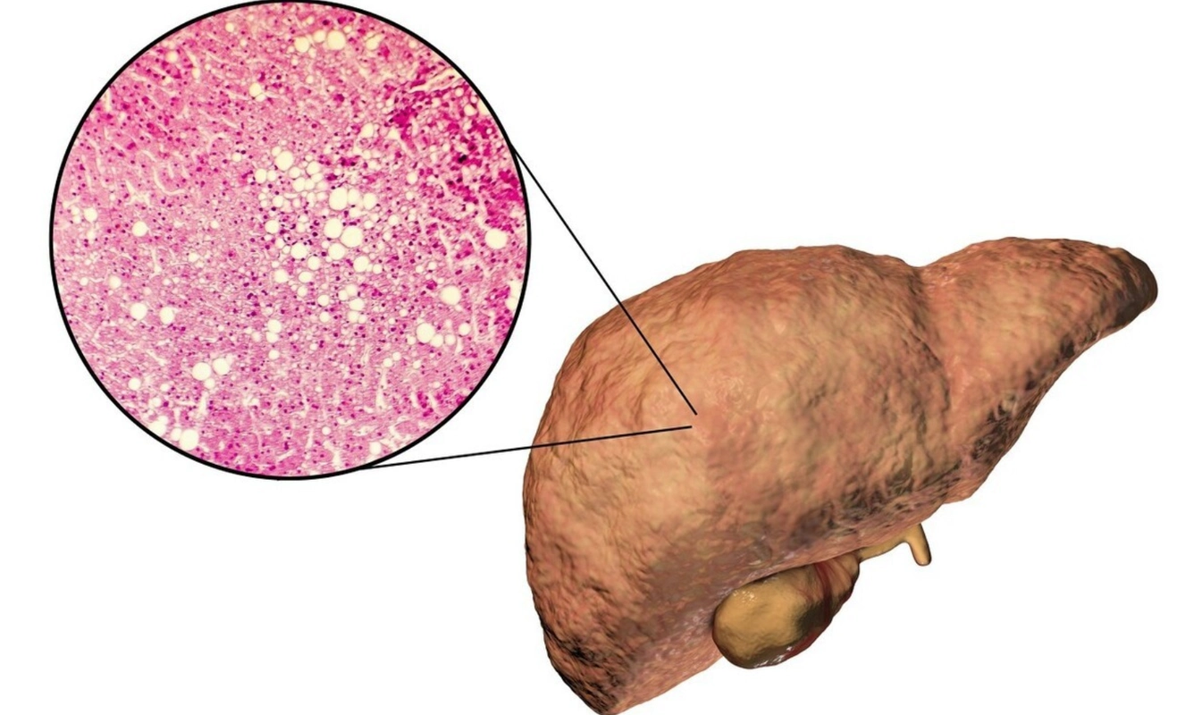 轻度脂肪肝,坚持吃素一年竟然变中度?医生为你详解具体原因