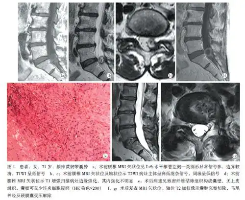 腰椎黄韧带囊肿1例
