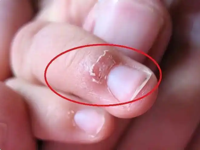 指甲后就说:"你看孩子发量稀少还偏黄,指甲上也有白斑,倒欠,这是缺锌