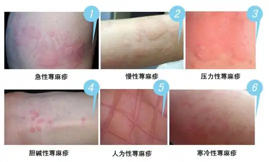 荨麻疹会传染吗?